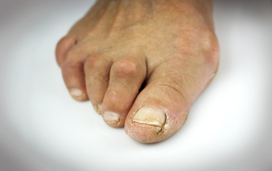 hammertoe