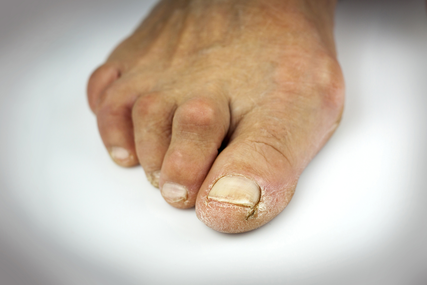 Hammer toe surgery: Types, what to expect, and recovery