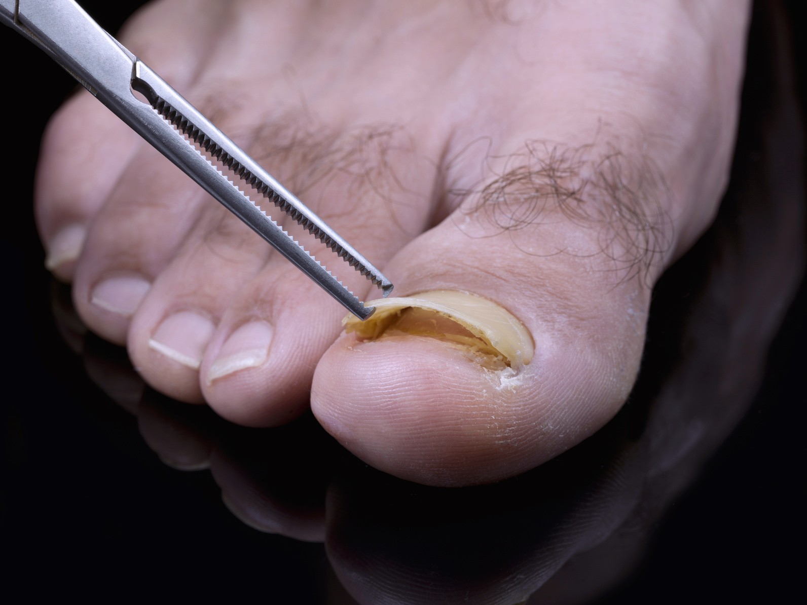 Close Nail Fungus Infection On Middle Stock Photo 662793394 | Shutterstock